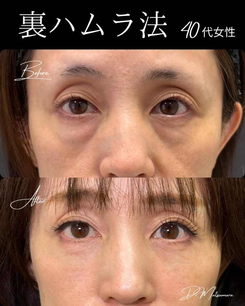 裏ハムラ法の症例写真 (13)