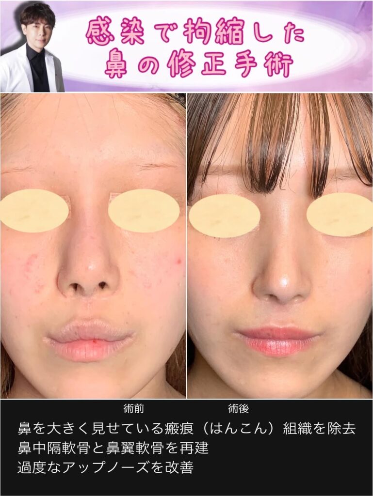 感染で拘縮した鼻を鼻中隔軟骨と鼻翼軟骨で再建した修正手術 (3)