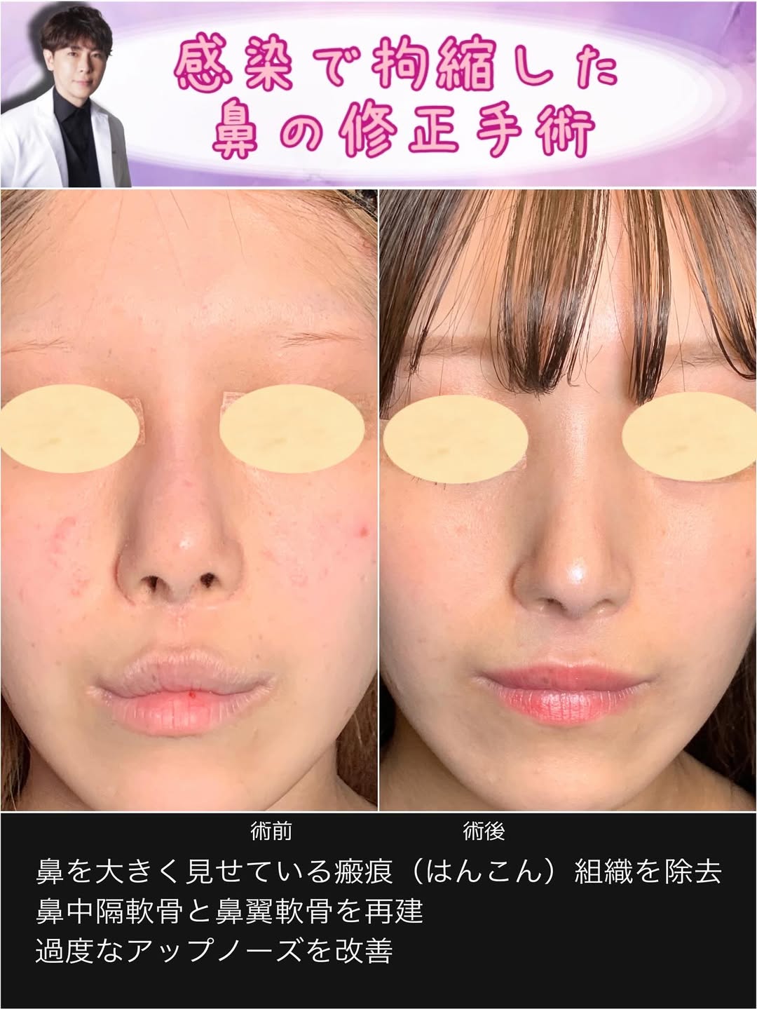 感染で拘縮した鼻の修正手術 - eクリニック京都院【公式】｜京都の美容