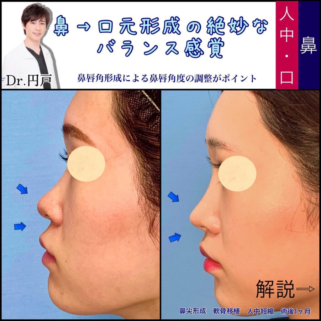 鼻尖形成と軟骨移植と人中短縮の症例写真 (1)