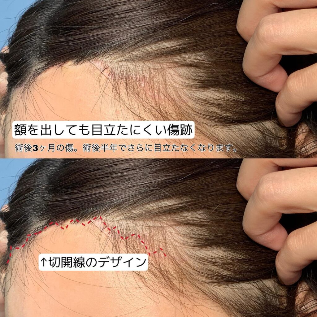 額リフトの症例写真 (2)