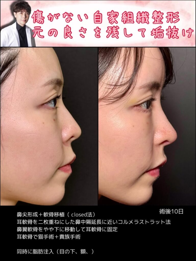 クローズド法の鼻尖形成と軟骨移植の症例写真 (6)