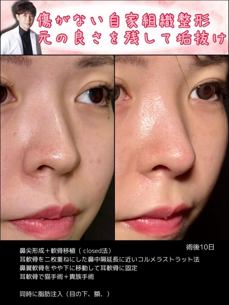 クローズド法の鼻尖形成と軟骨移植の症例写真 (4)