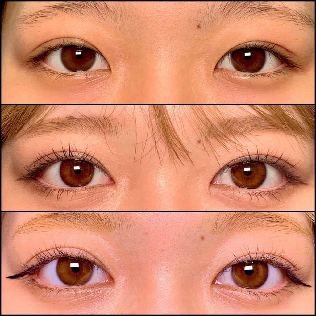 目頭切開と下瞼拡大と目尻靭帯移動の症例写真 (2)