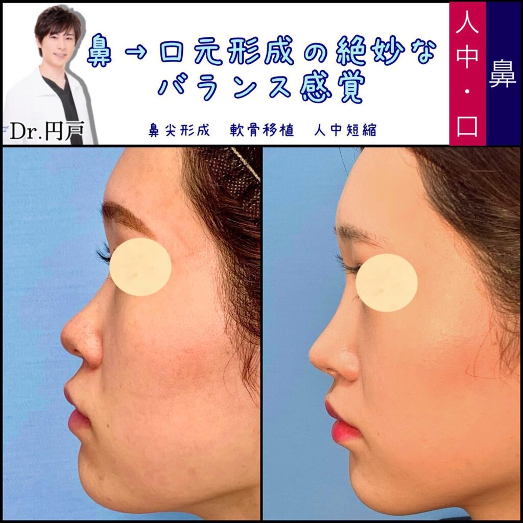 鼻尖形成と軟骨移植と人中短縮の症例写真 (2)