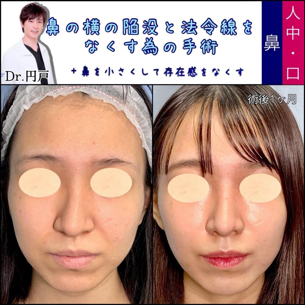 貴族手術の症例写真 (6)