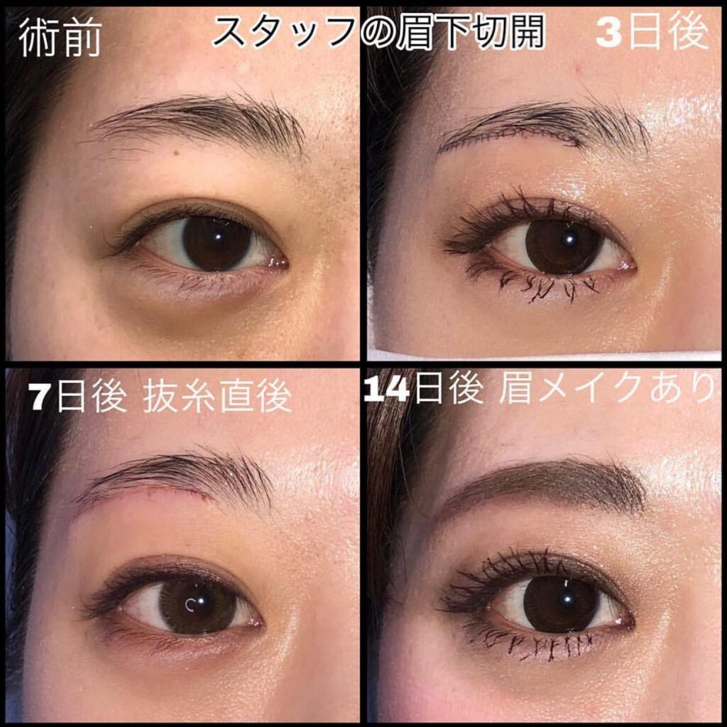 眉下切開の症例 (2)