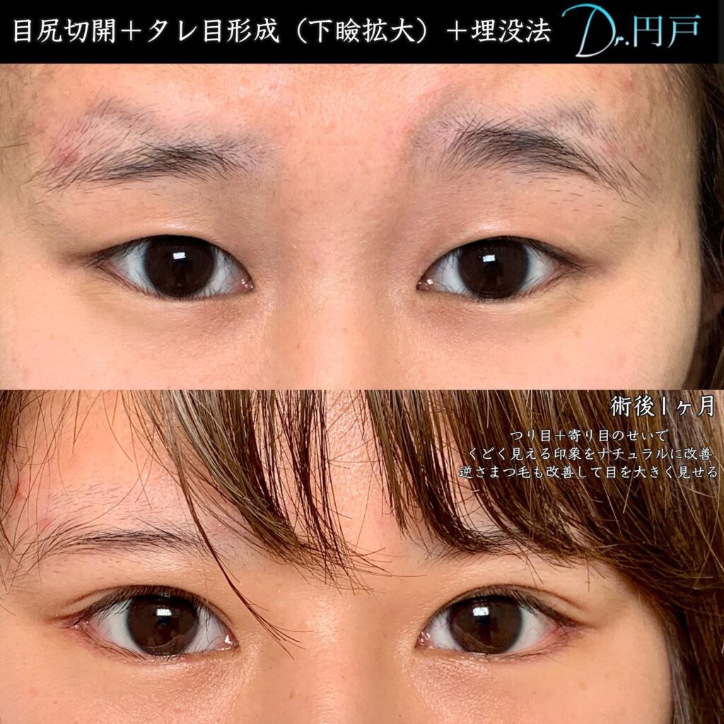 目尻切開とタレ目形成と埋没法の症例写真