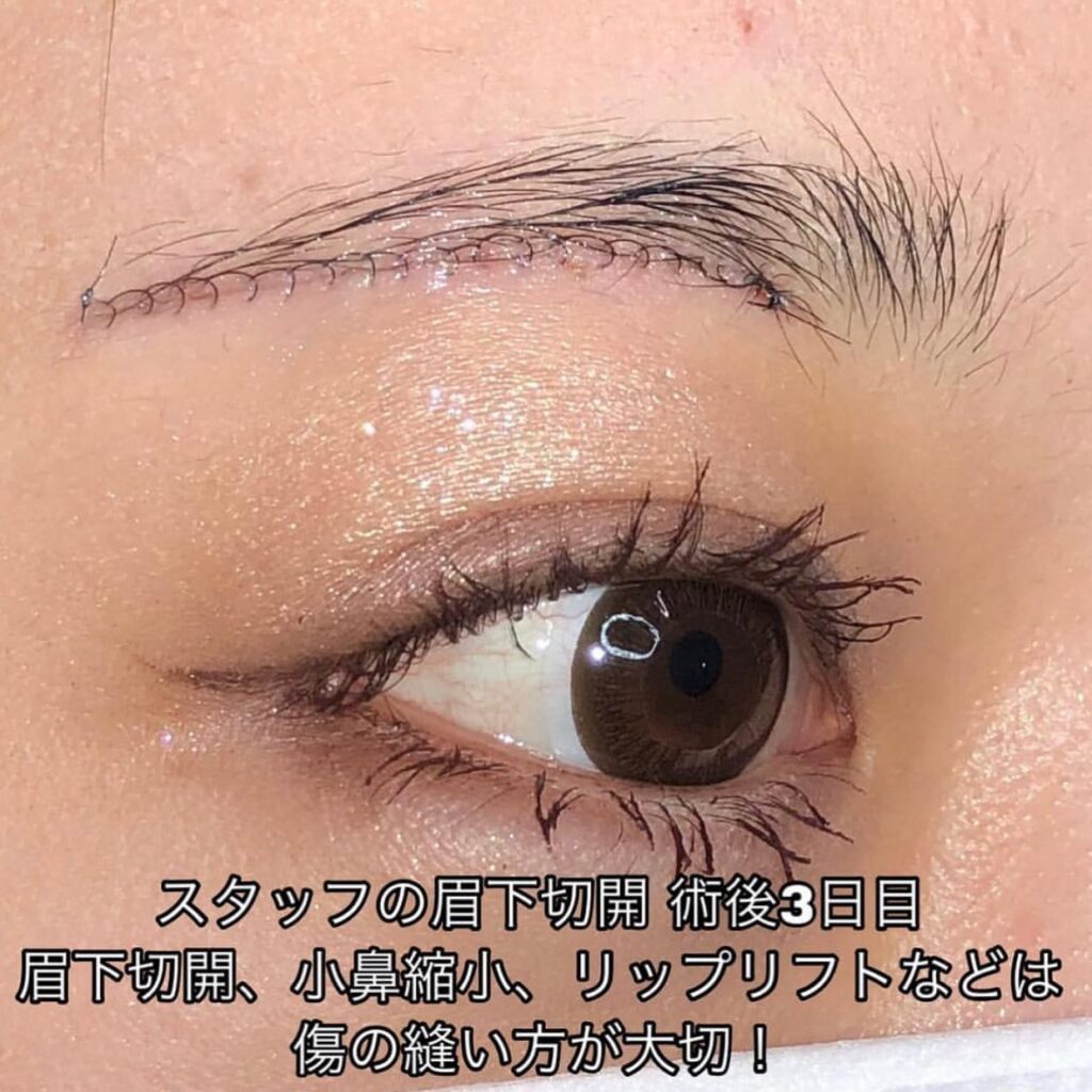 眉下切開の症例 (1)