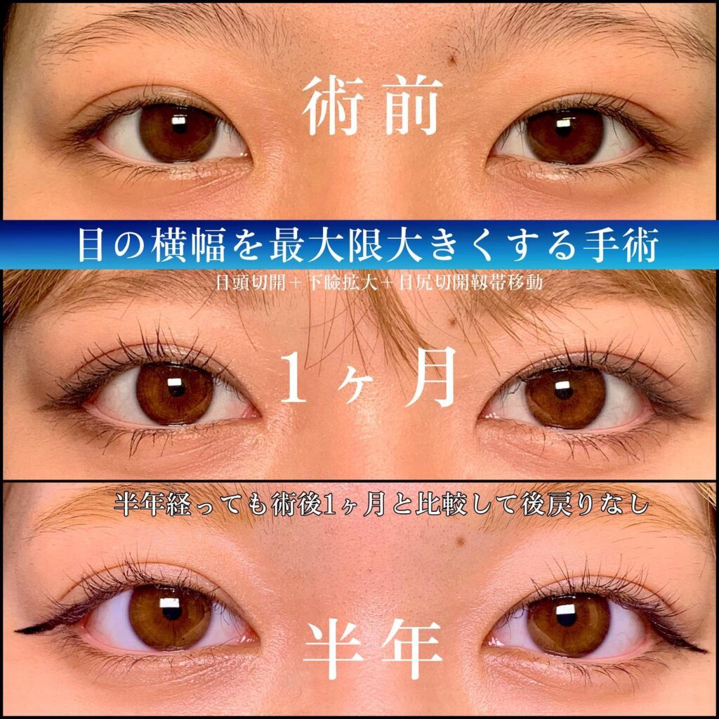 目頭切開と下瞼拡大と目尻靭帯移動の症例写真 (1)