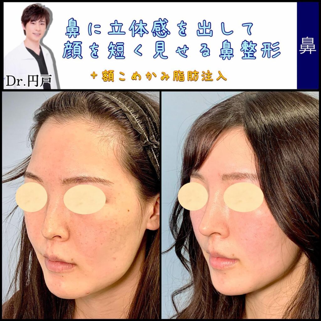 鼻尖形成と鼻中隔延長と脂肪注入の症例写真 (2)