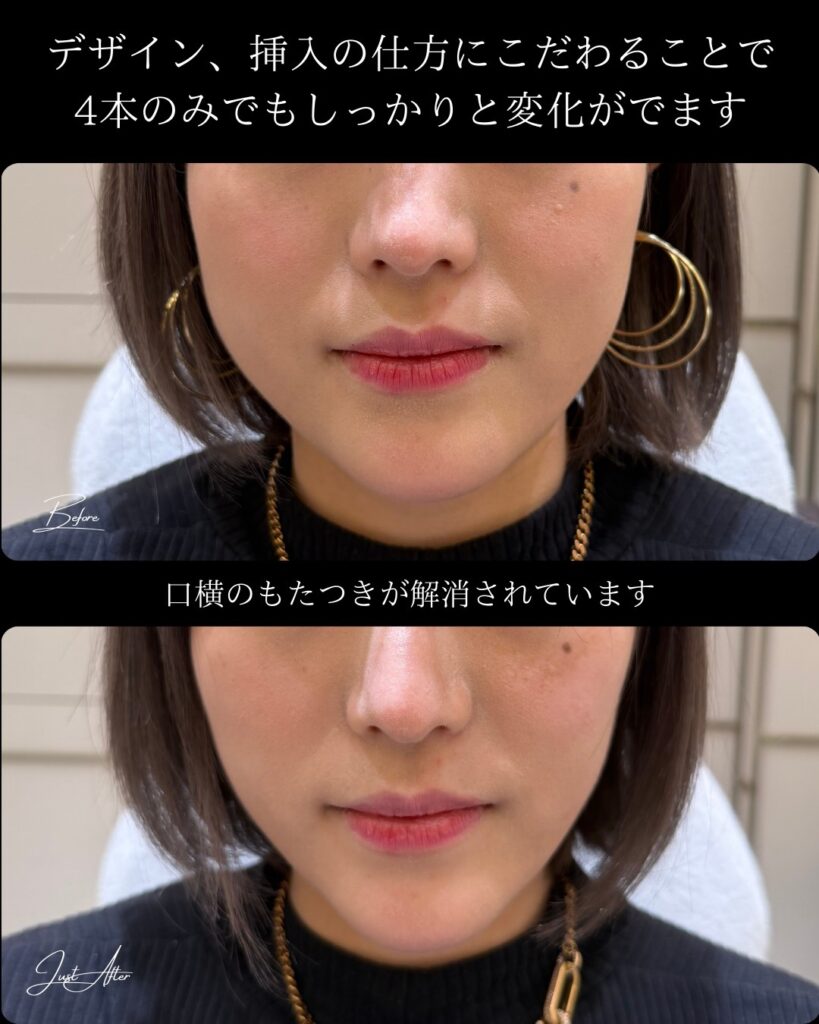 糸リフトの症例写真 (20)