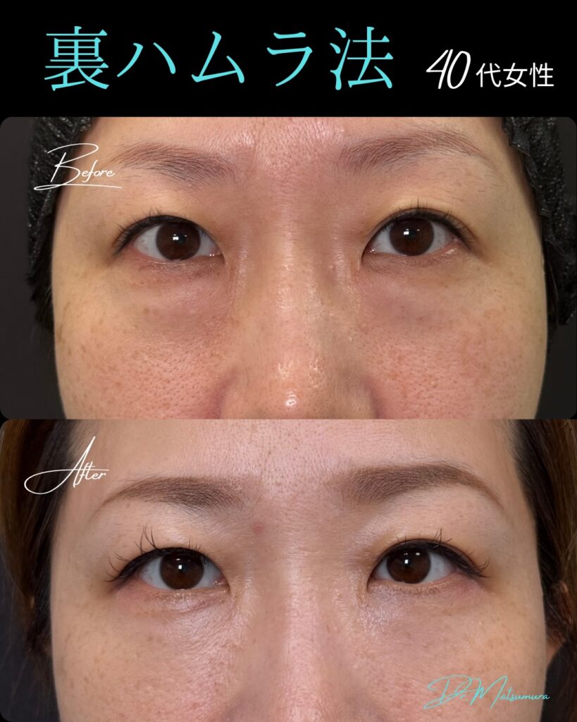 裏ハムラ法の症例写真 (17)