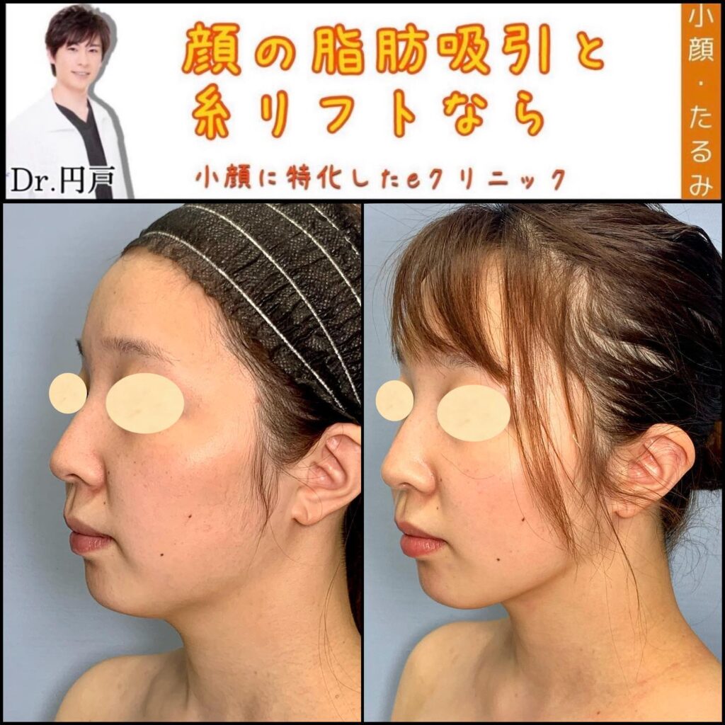 顔の脂肪吸引と糸リフトの症例写真 (11)