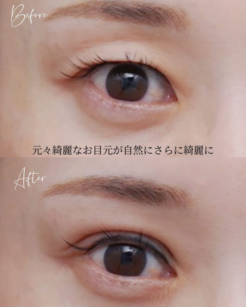 埋没法の症例写真 (9)