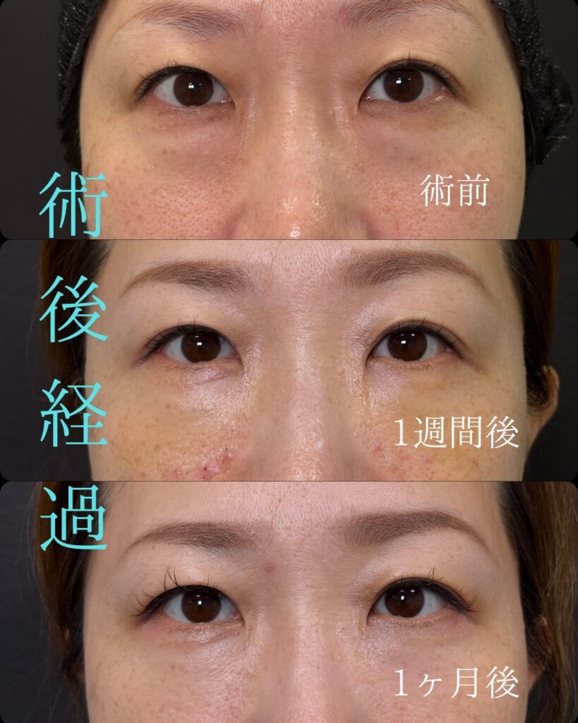 裏ハムラ法の症例写真 (18)