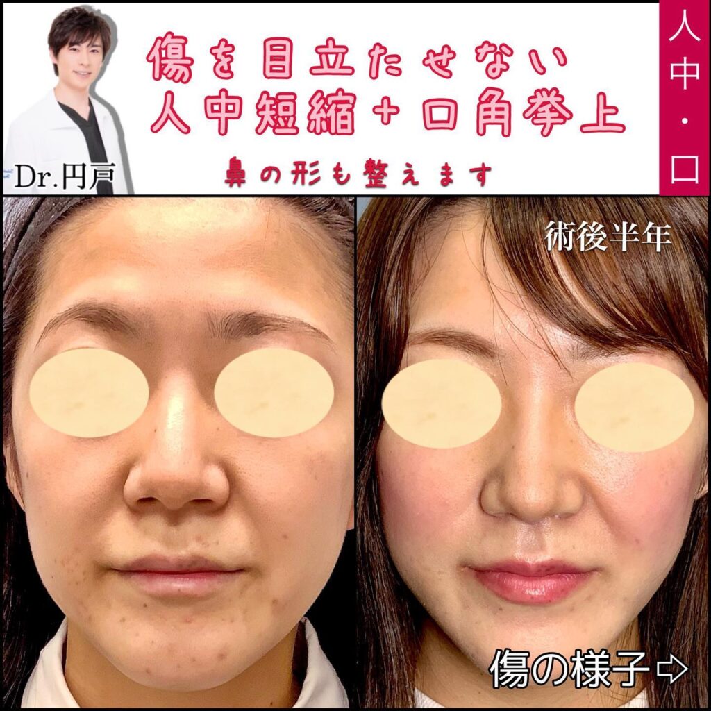 人中短縮と口角挙上の症例写真