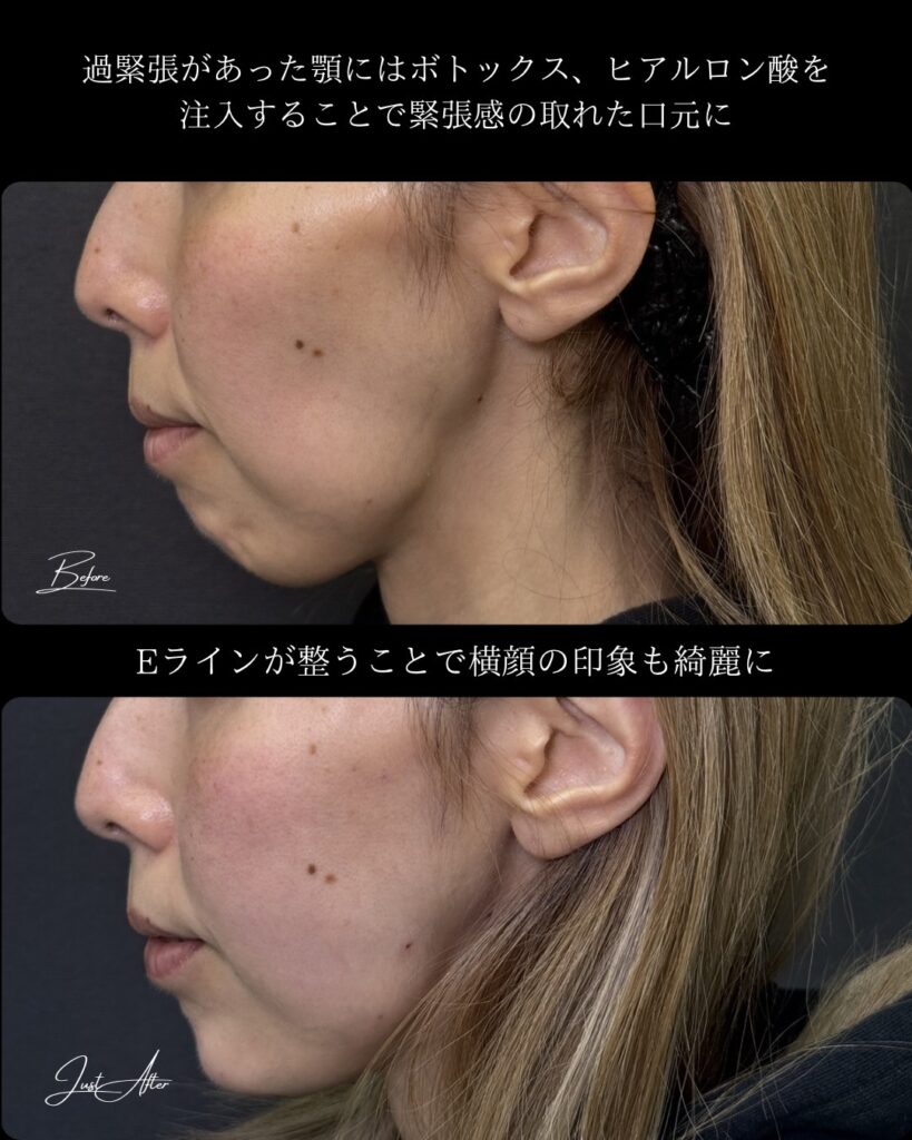 頬とこめかみと顎と目の上のヒアルロン酸の症例写真 (3)
