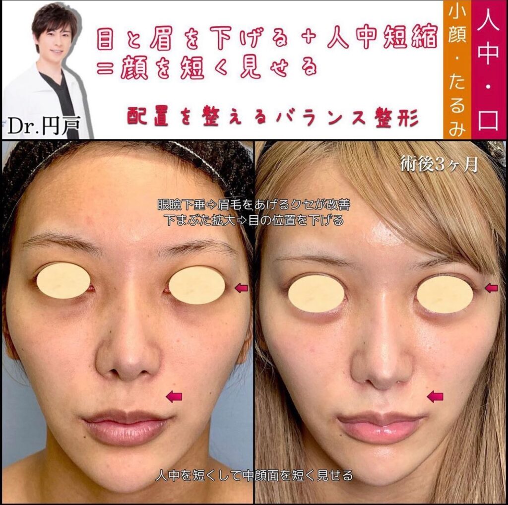 人中短縮と外側人中短縮と口角挙上とM字リップと眼瞼下垂と下瞼拡大の症例写真
