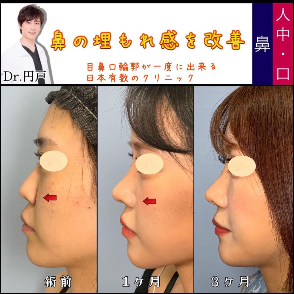 顔の脂肪吸引と脂肪注入と鼻の美容整形の症例写真 (1)