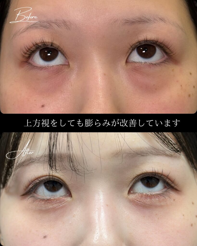 裏ハムラ法の症例写真 (21)