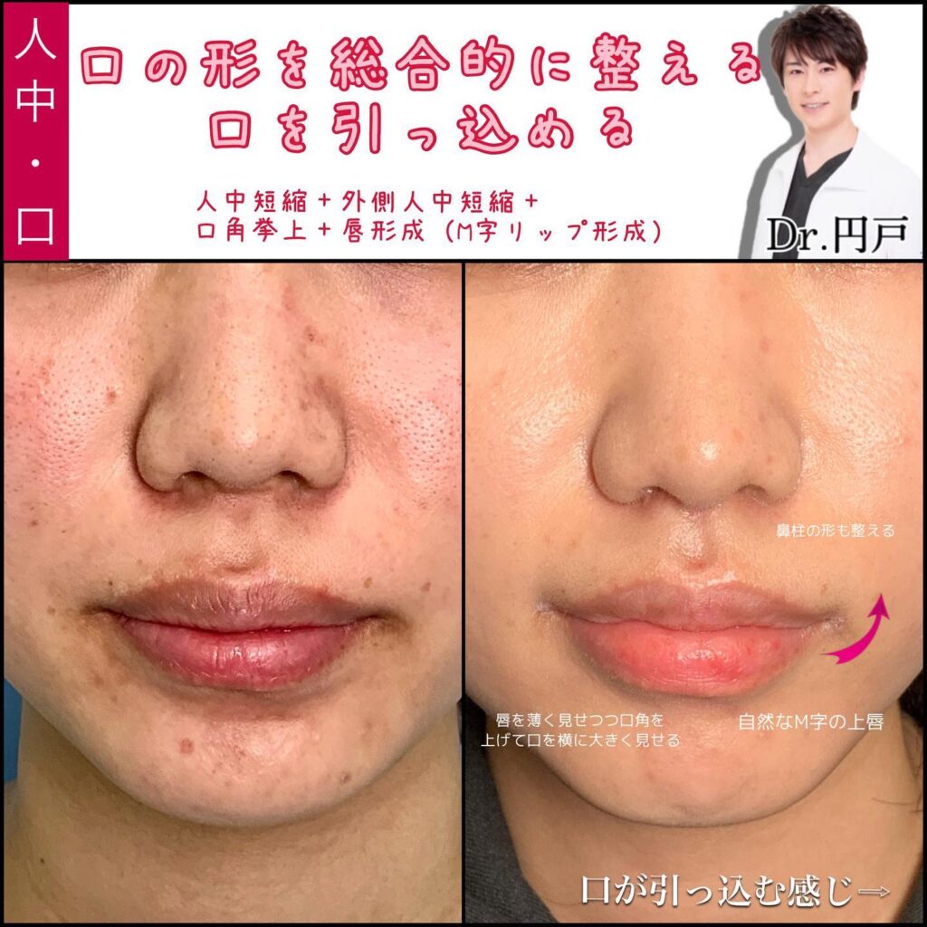 人中短縮と外側人中短縮と口角挙上とM字リップ形成の症例写真