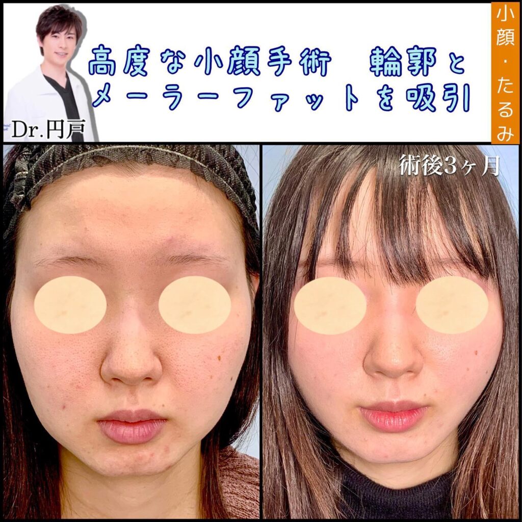 頬と顎下の脂肪吸引とメーラーファットの症例写真 (3)