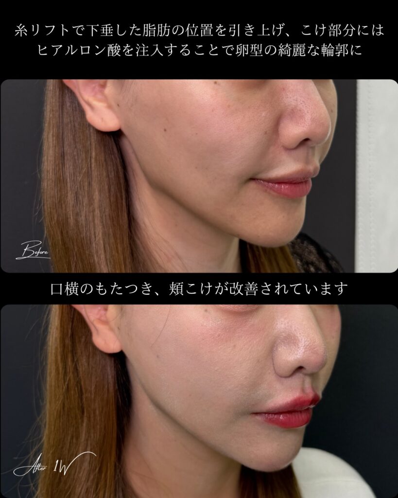 糸リフトの症例写真 (18)