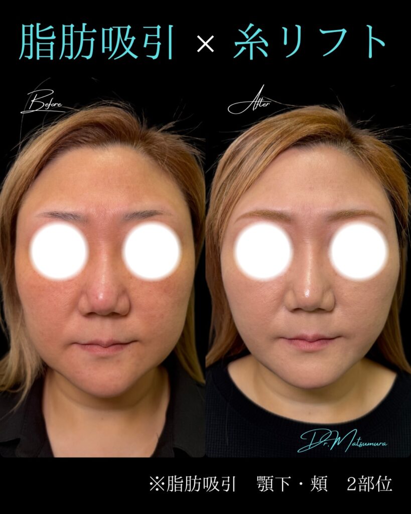 顎下と頬の脂肪吸引と糸リフトの症例写真 (3)