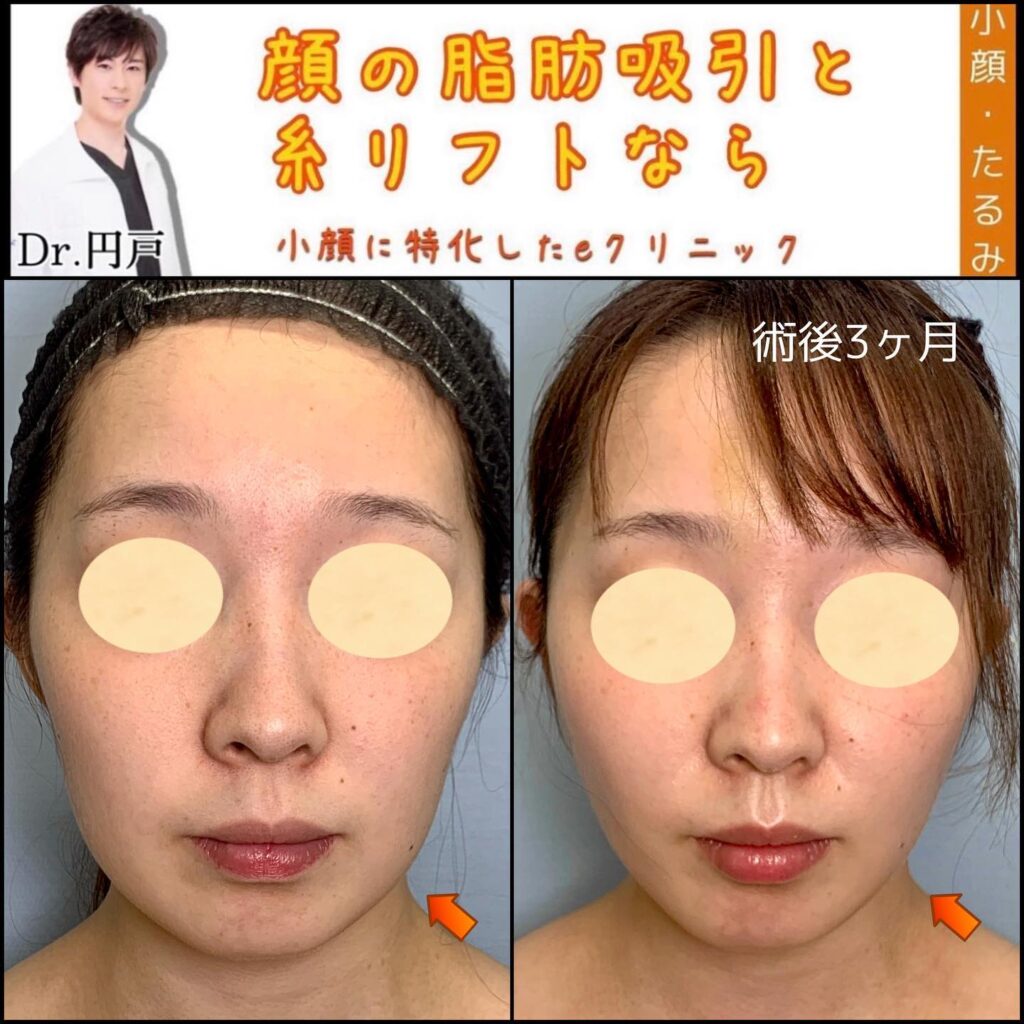 顔の脂肪吸引と糸リフトの症例写真 (10)