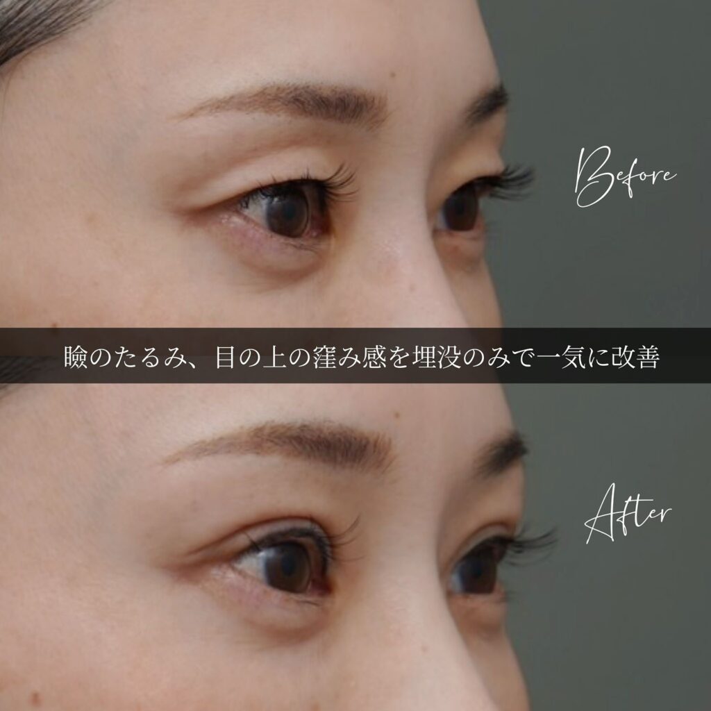 埋没法の症例写真 (13)