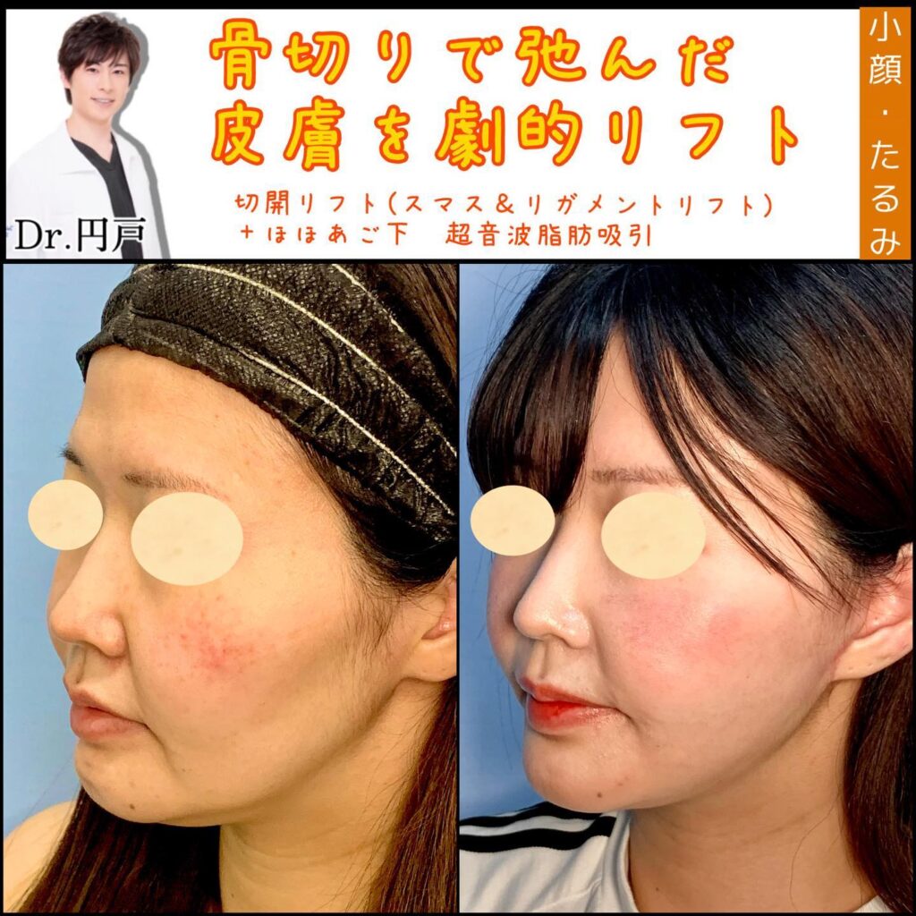 切開リフトと頬と顎下の脂肪吸引の症例写真 (2)