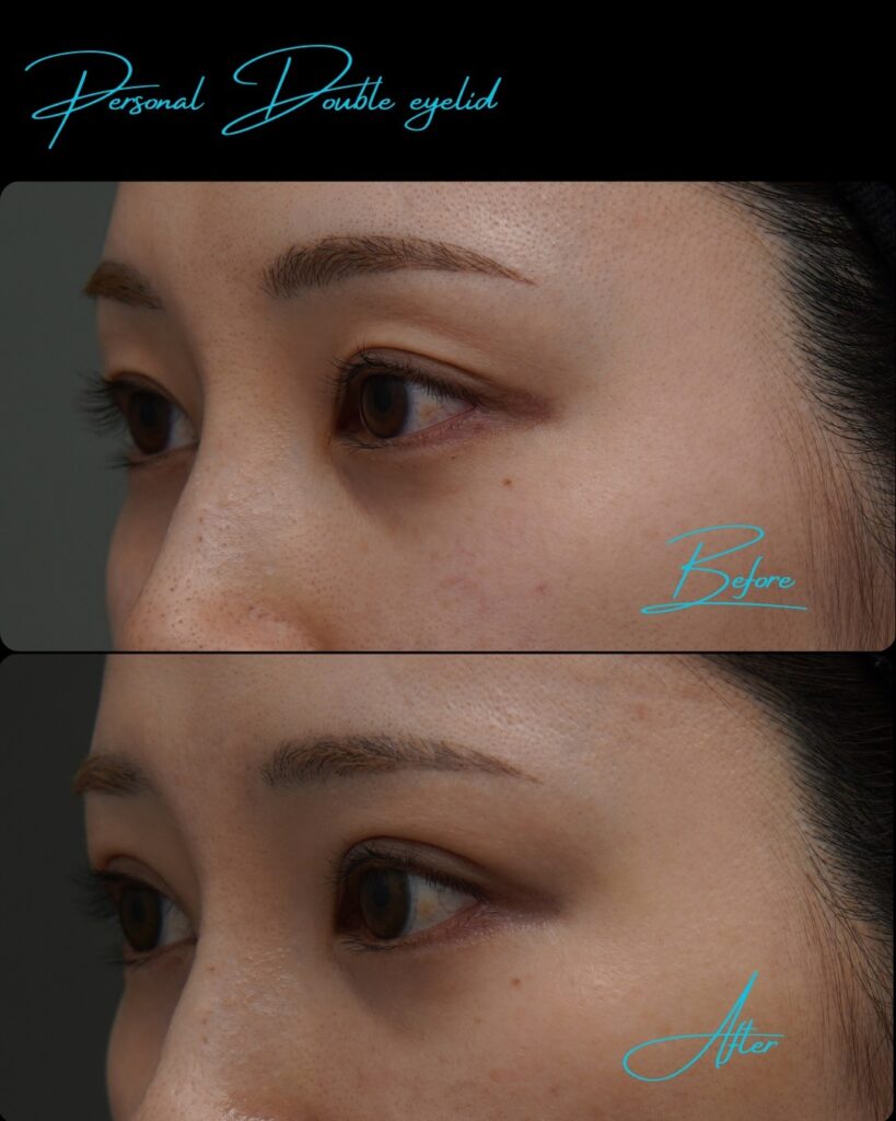 埋没法の症例写真 (16)