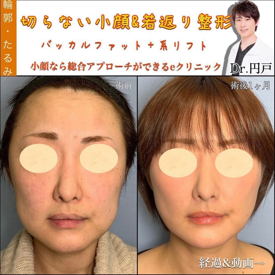 バッカルファットと糸リフトの症例写真 (4)