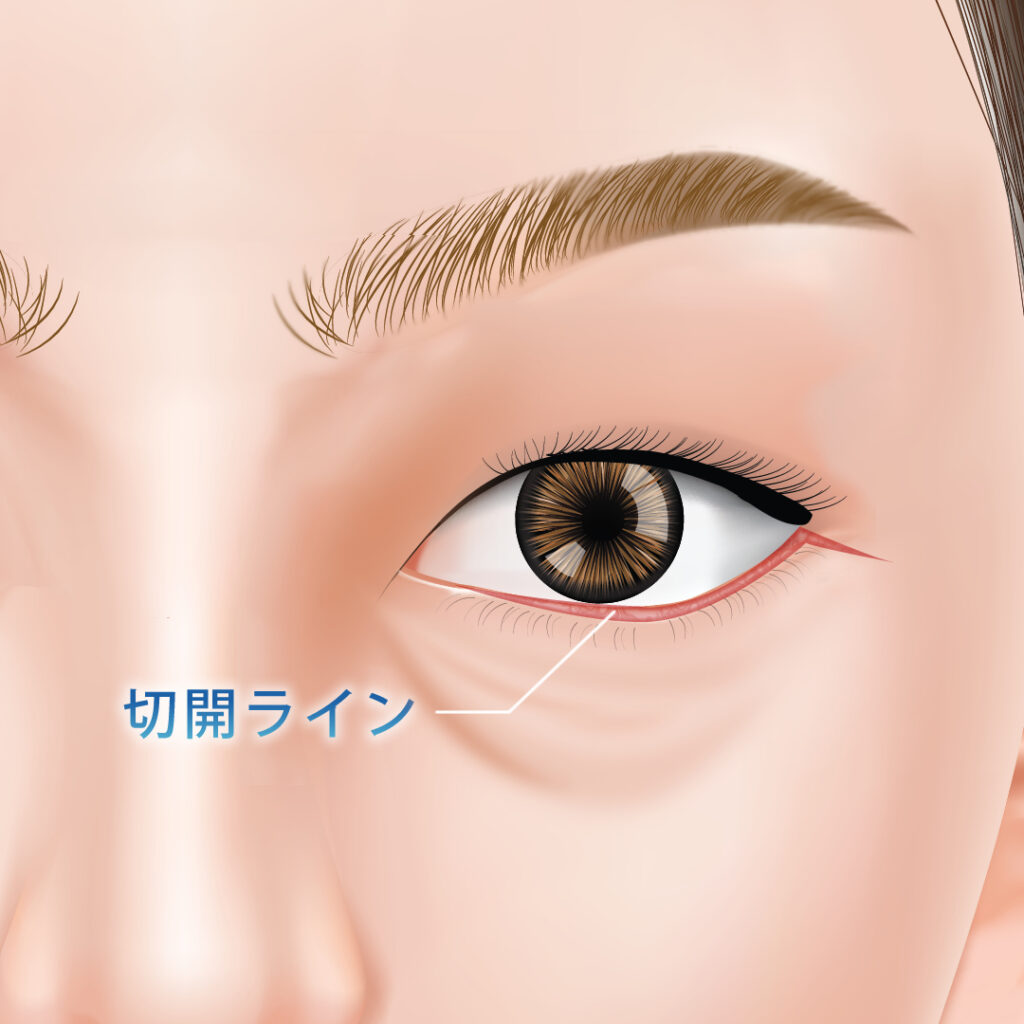 表ハムラ法の切開ライン