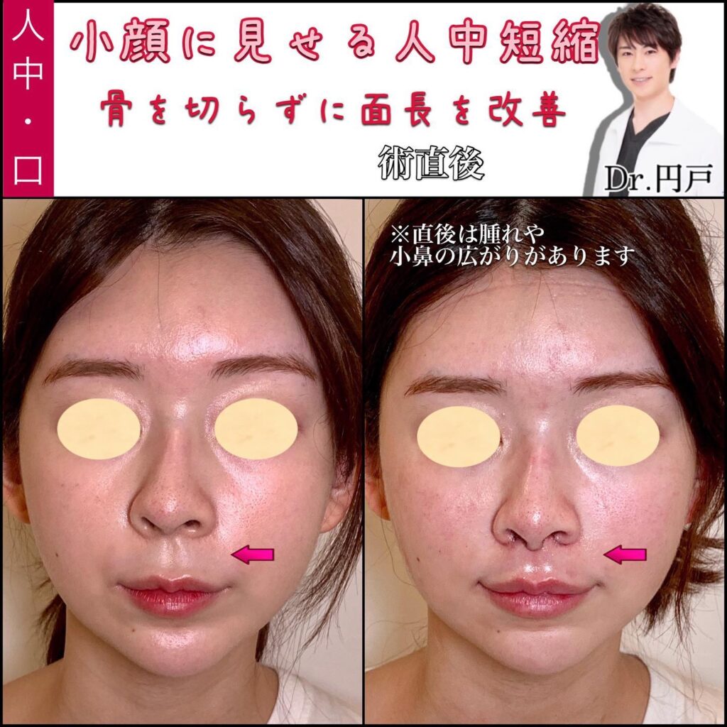 人中短縮の症例写真 (2)