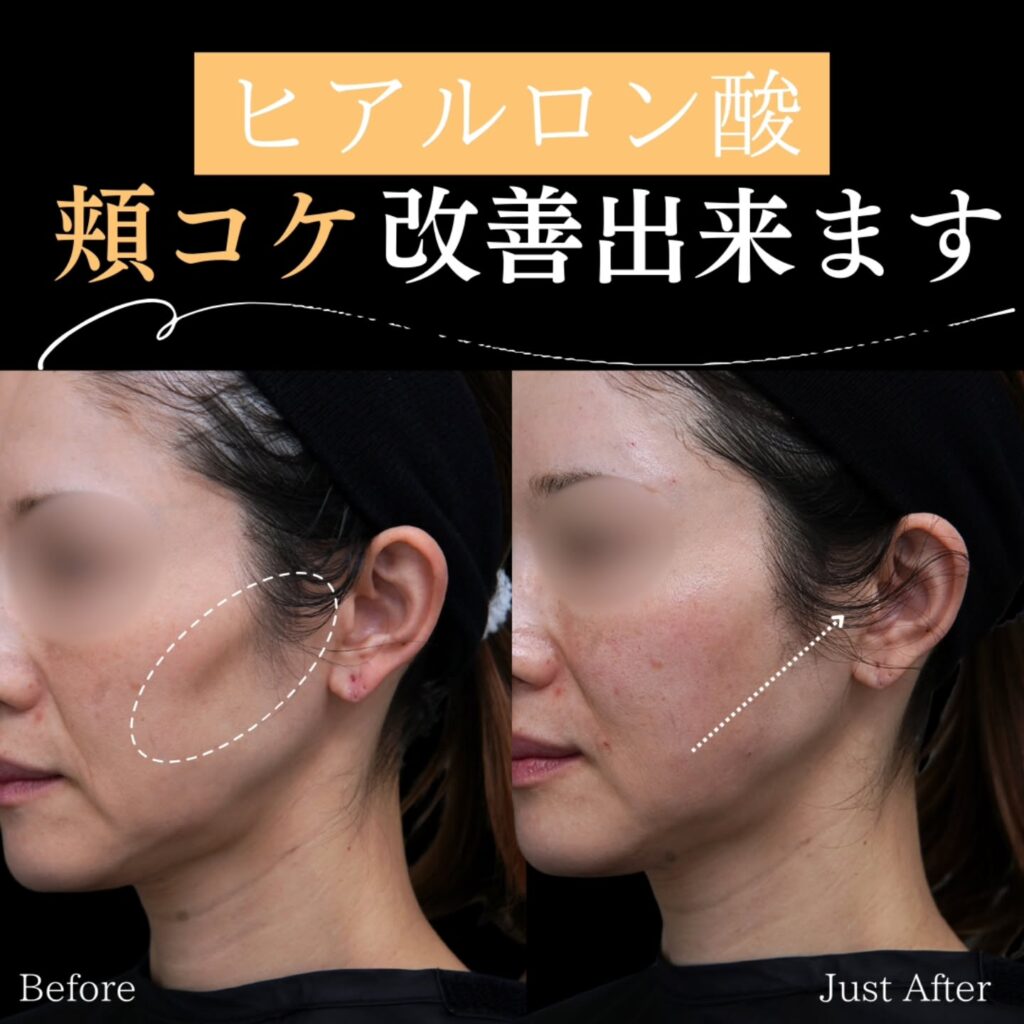 頬とほうれい線とおでこのヒアルロン酸の症例写真