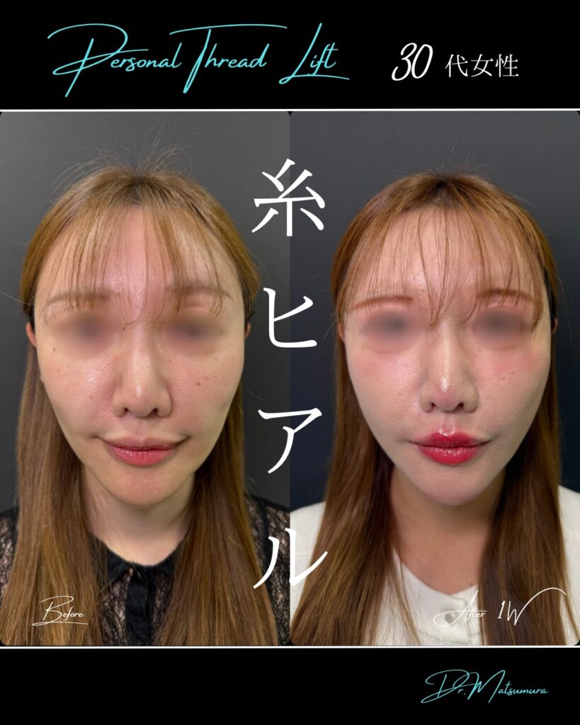 糸リフトの症例写真 (16)