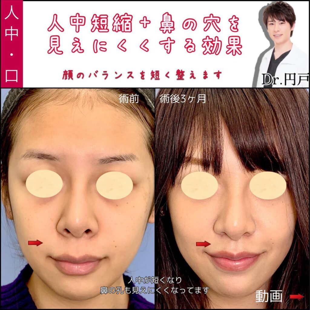 人中短縮の症例写真 (3)