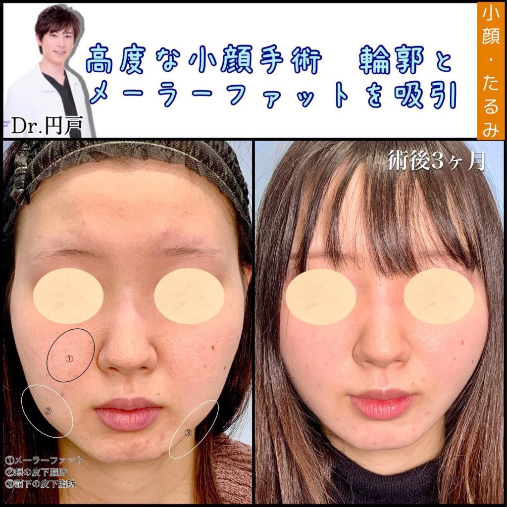 頬と顎下の脂肪吸引とメーラーファットの症例写真 (1)
