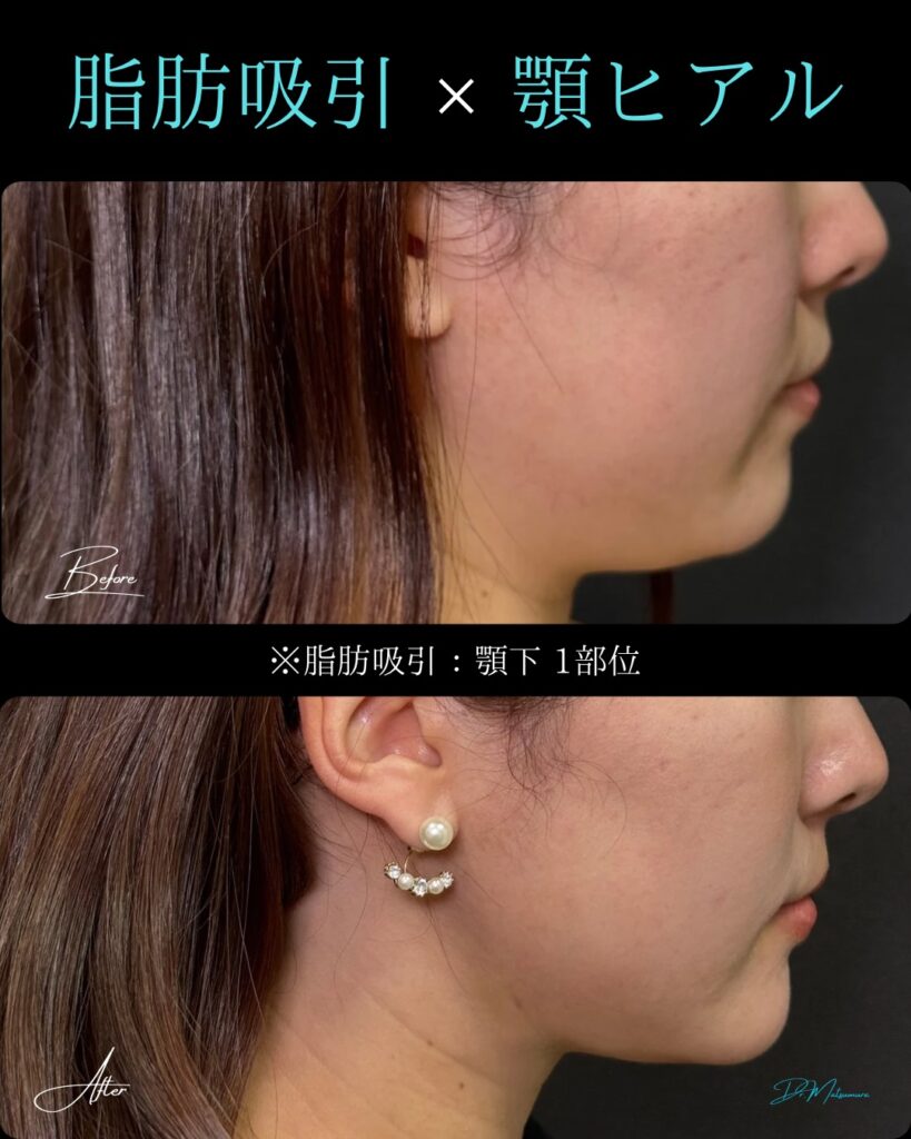 顎下の脂肪吸引と顎のヒアルロン酸の症例写真 (1)