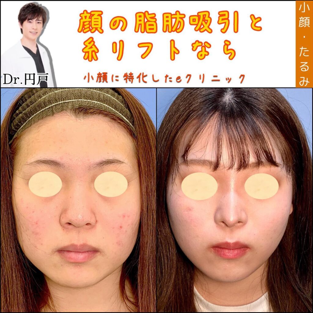 顔の脂肪吸引と糸リフトの症例写真 (5)