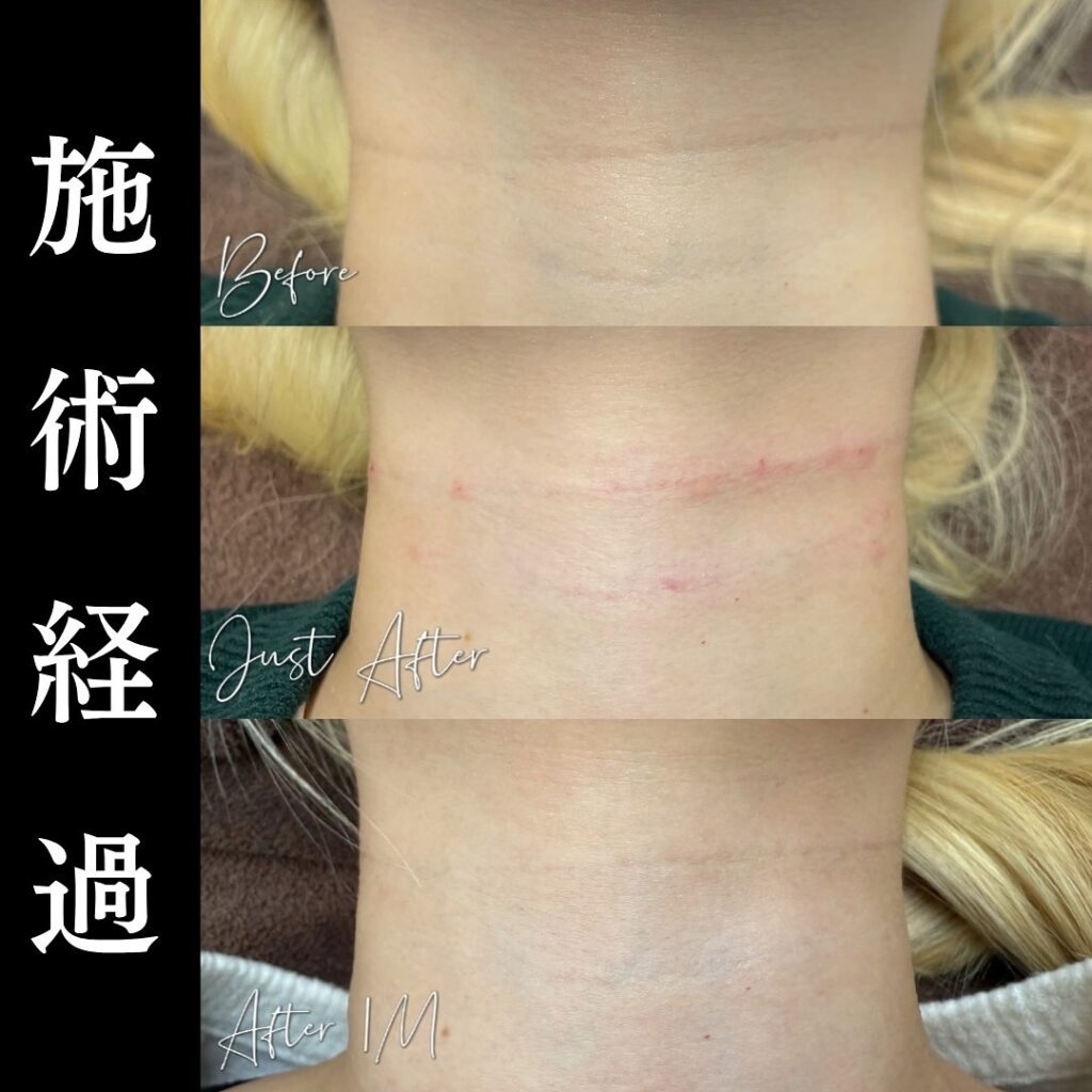 首のヒアルロン酸注入の症例写真