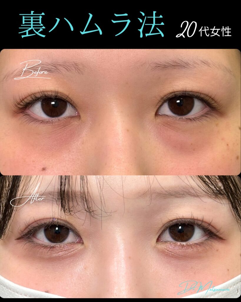 裏ハムラ法の症例写真 (23)