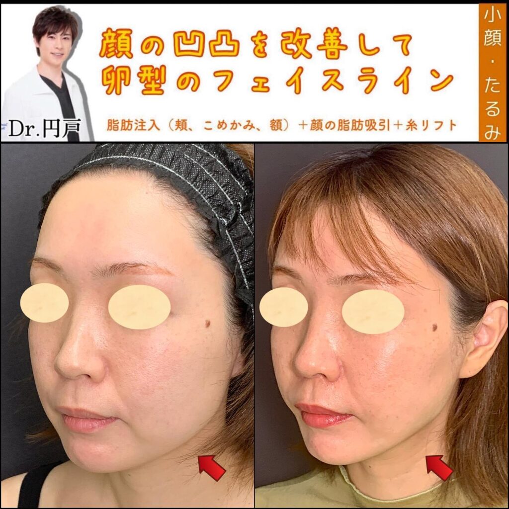 脂肪注入と顔の脂肪吸引と糸リフトの症例写真