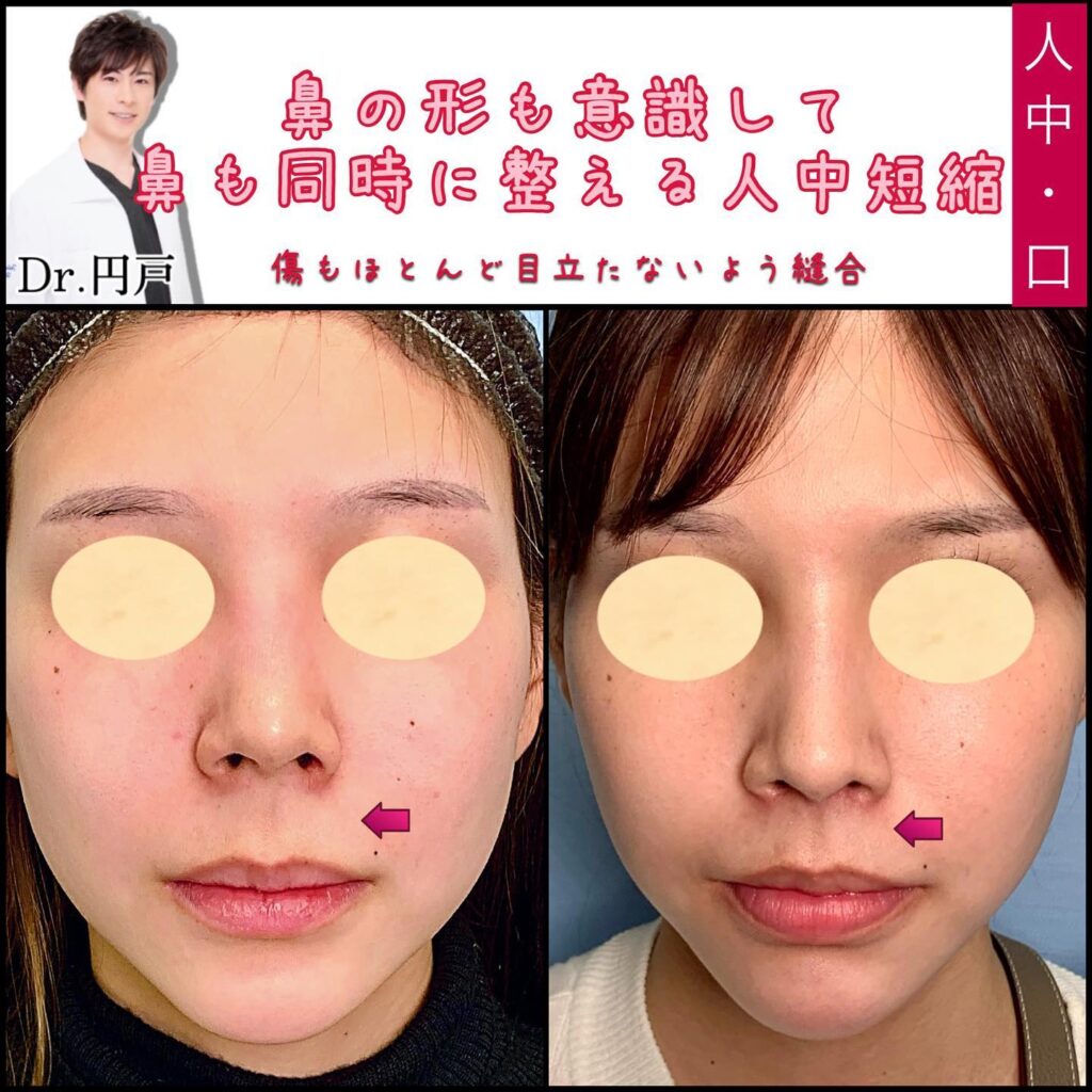 人中短縮の症例写真 (4)