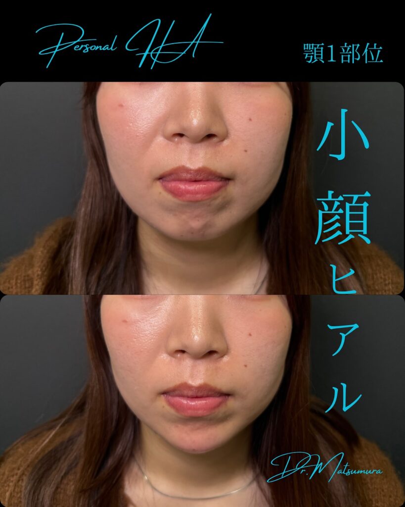 顔のヒアルロン酸の症例写真