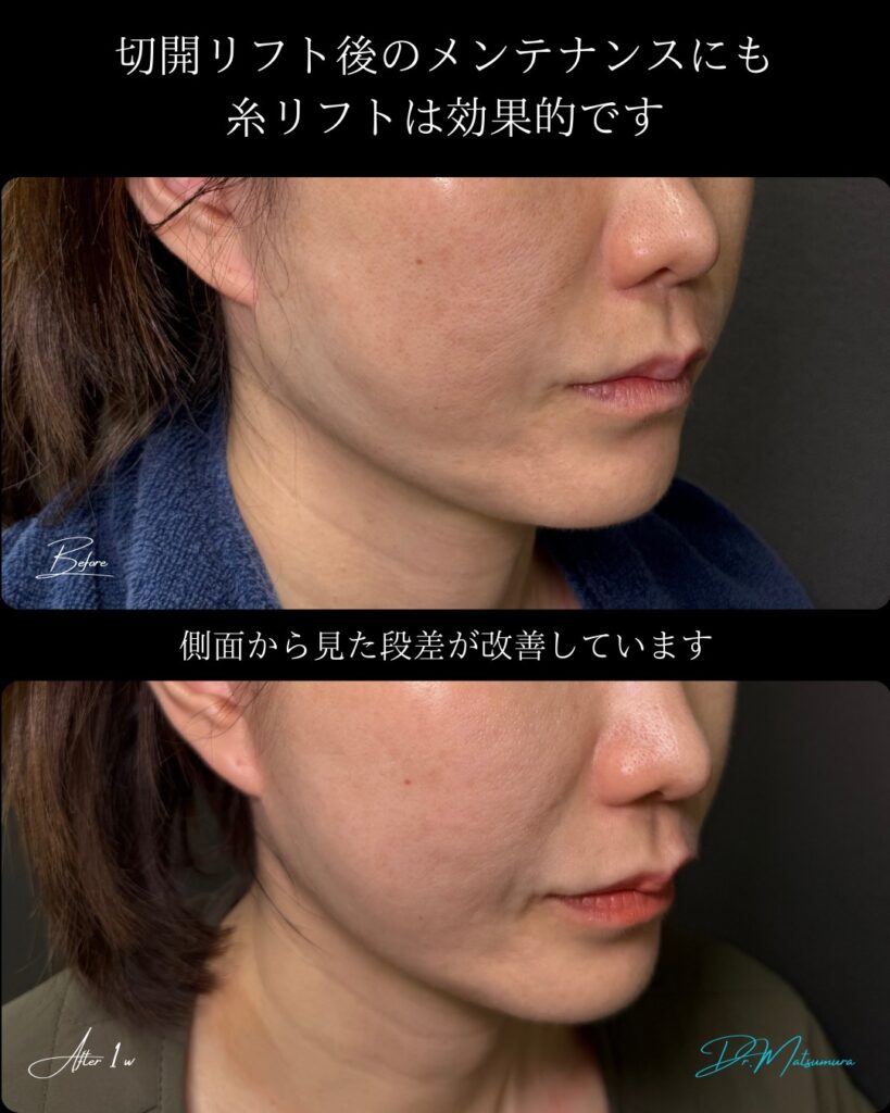 糸リフトの症例写真 (15)