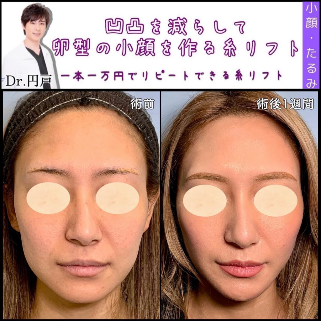 糸リフトの症例写真 (15)