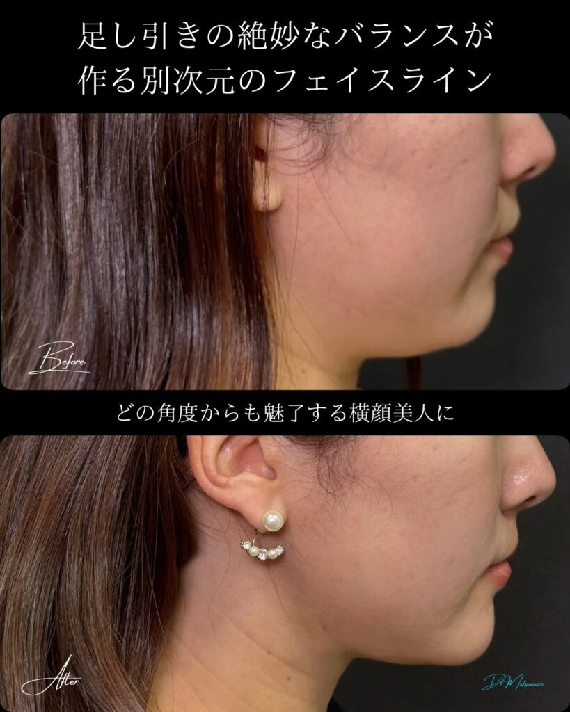 顎下の脂肪吸引と顎のヒアルロン酸の症例写真 (2)